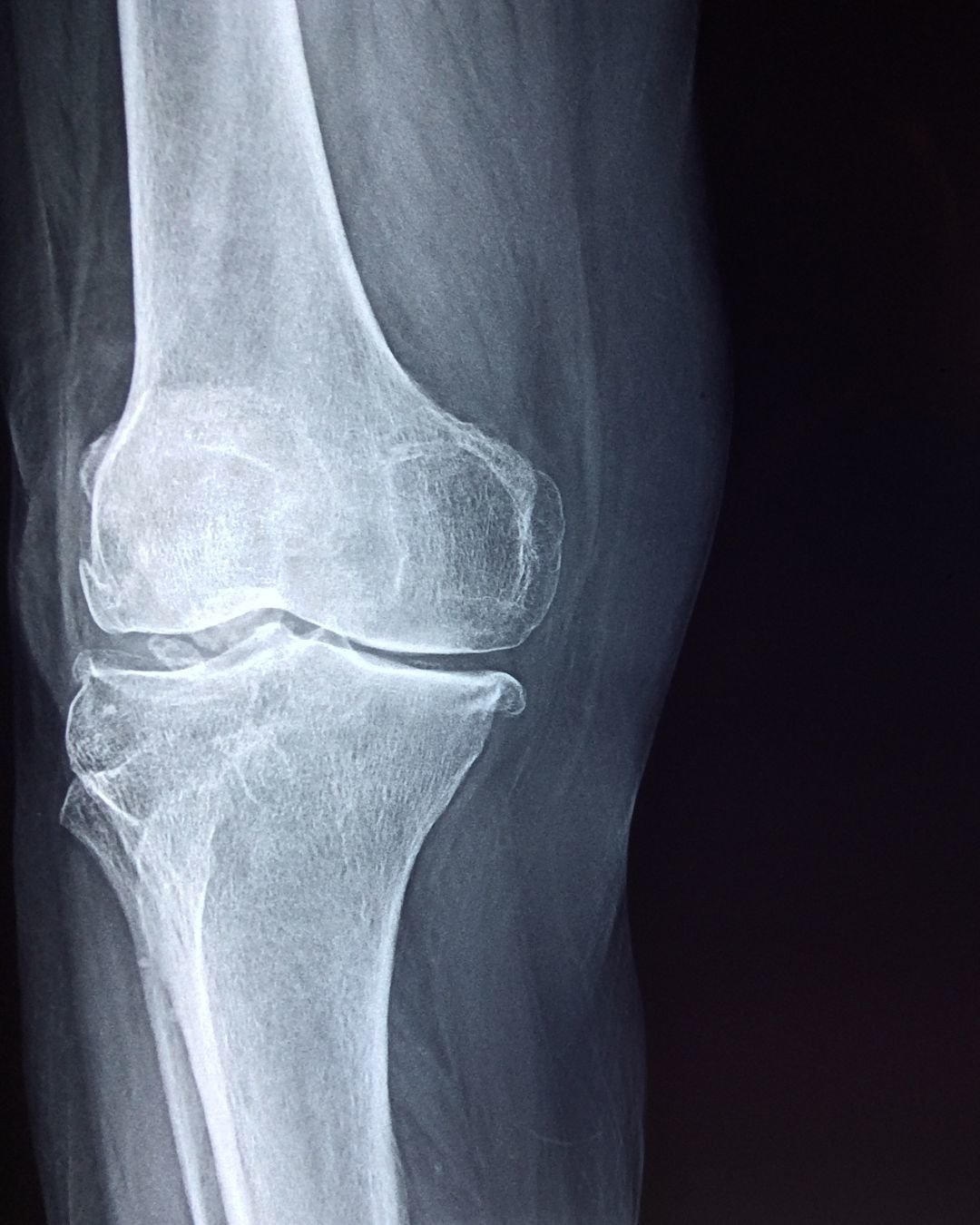 osteoperosis month
